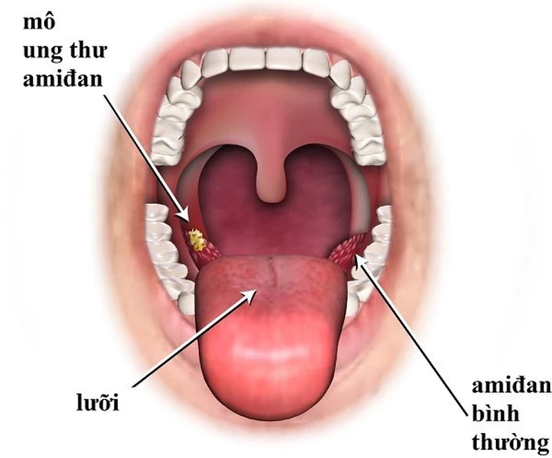 Nổi hạch ở xương quai xanh là dấu hiệu của bệnh gì? - Tìm hiểu ngay! 2