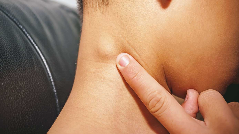 Nổi hạch sau gáy cảnh báo bệnh lý ung thư