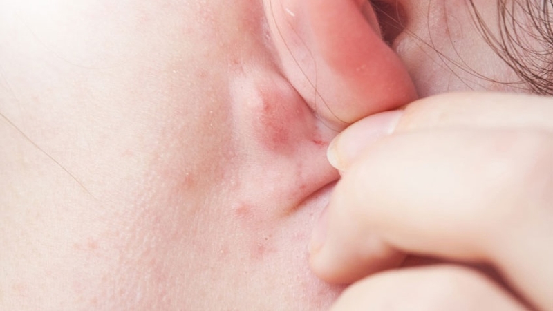 Nhiều người nhầm lẫn mụn trứng cá với hạch sau tai