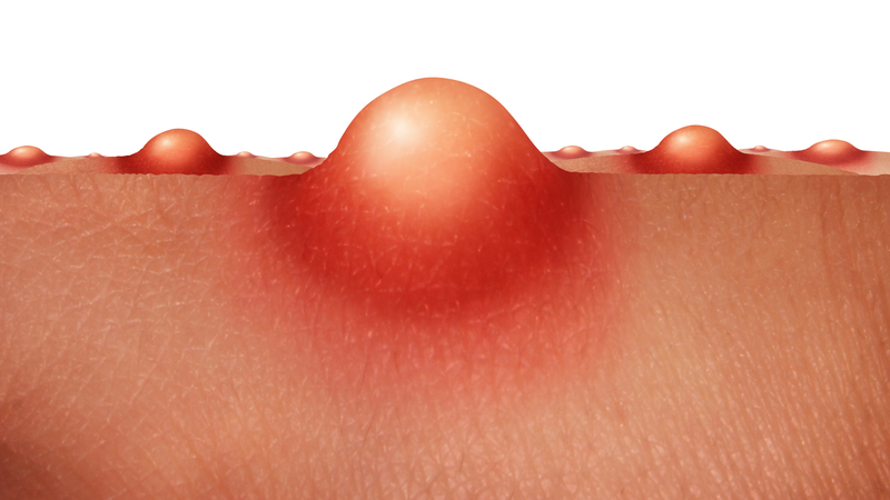 Mụn trứng cá thường bị nhầm lẫn với tình trạng nổi hạch sau tai