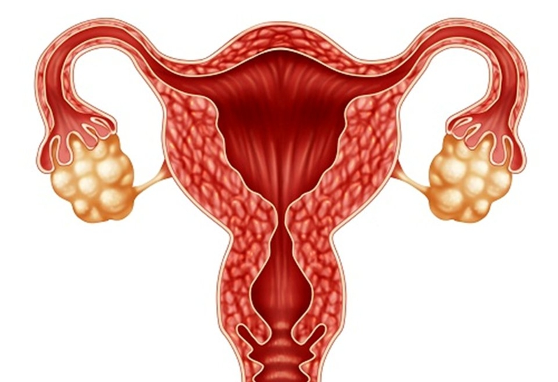 Nội mạc tử cung dày báo hiệu bệnh gì? 2