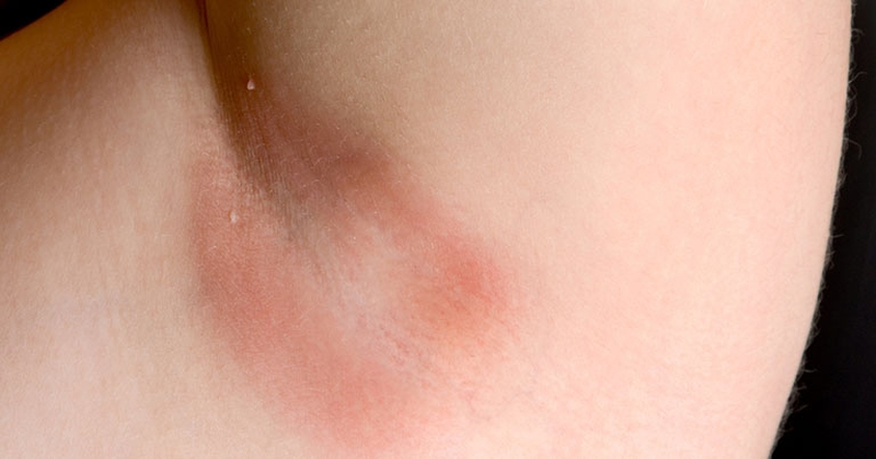 Viêm da dị ứng vùng nách: Nguyên nhân và cách điều trị 5
