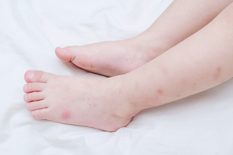 Nổi mề đay dị ứng ở trẻ có nguy hiểm không?