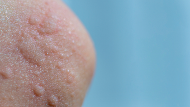 Nổi mề đay khi trời lạnh: Làm thế nào để nhận biết và xử lý? 1