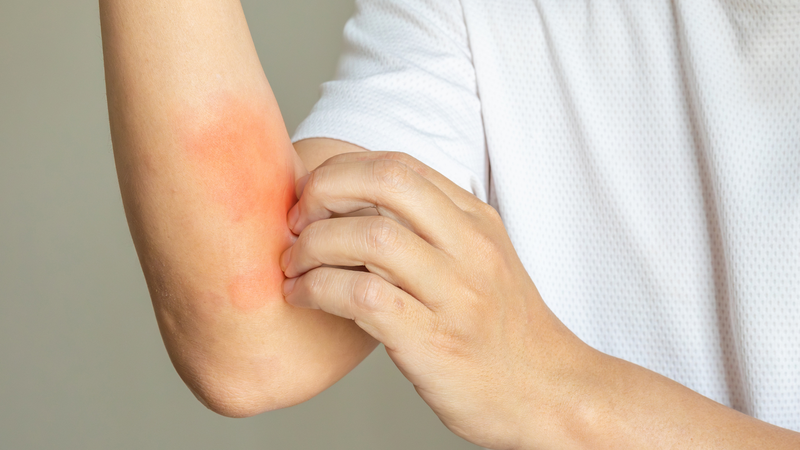 Nổi mề đay khi trời lạnh: Làm thế nào để nhận biết và xử lý? 2
