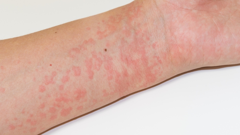 Nổi mề đay kiêng gì? Một số thực phẩm cần tránh 5