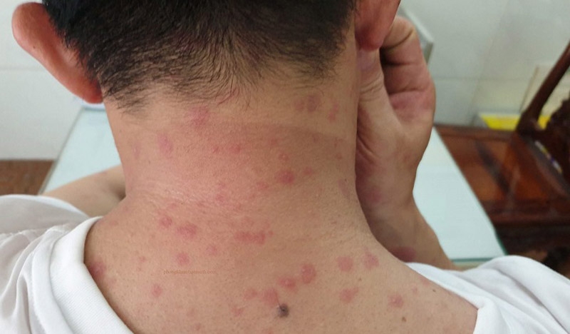 Hướng dẫn sơ cứu khi bị rết cắn 2