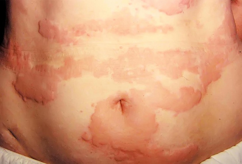 Nguyên nhân gây nổi mề đay ở bụng.