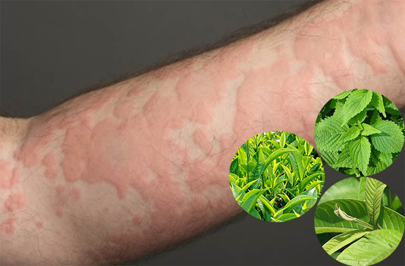 Nổi mề đay tắm lá gì nhanh khỏi? 1