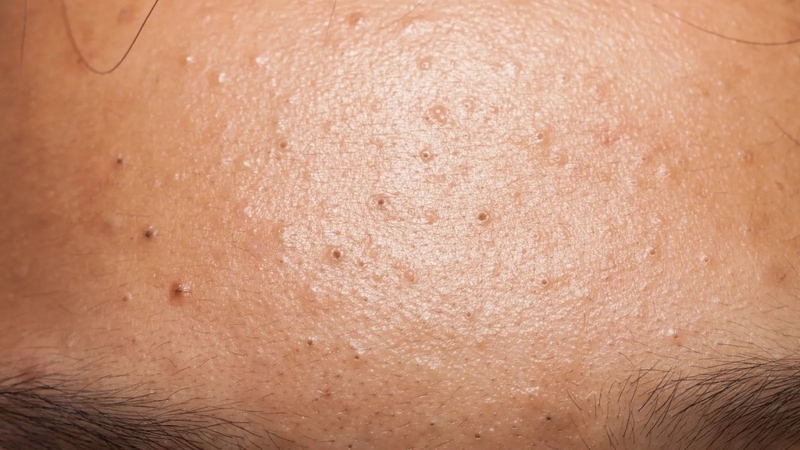 Nổi mụn ẩn trên trán nguyên nhân do đâu? Cách điều trị và những điều cần lưu ý 5