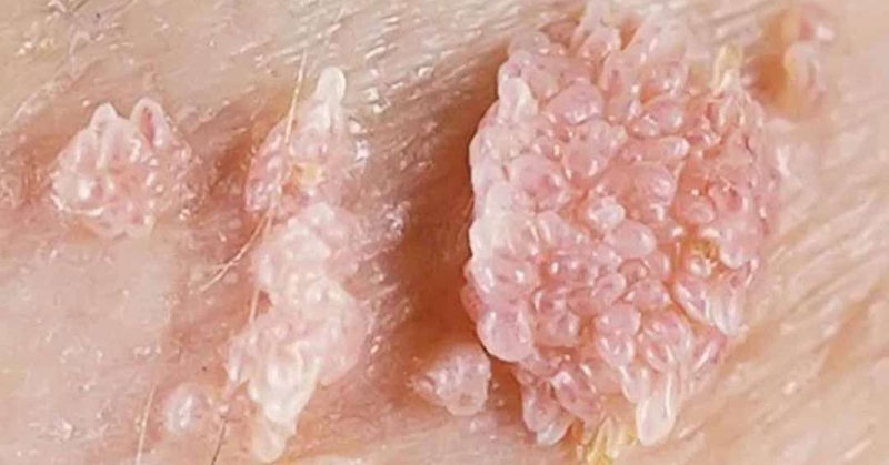 Nổi mụn cứng ở vùng kín là bệnh gì và điều trị như thế nào? 2