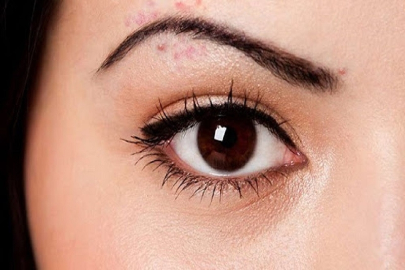 Nổi mụn ở chân mày - Nguyên nhân và cách điều trị 1
