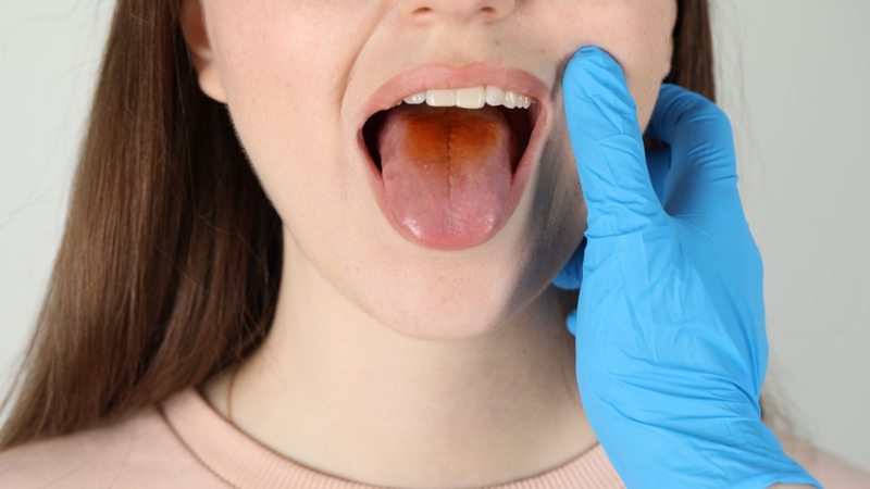 Mụn ở lưỡi kéo dài hoặc thay đổi bất thường là lý do nên đi kiểm tra