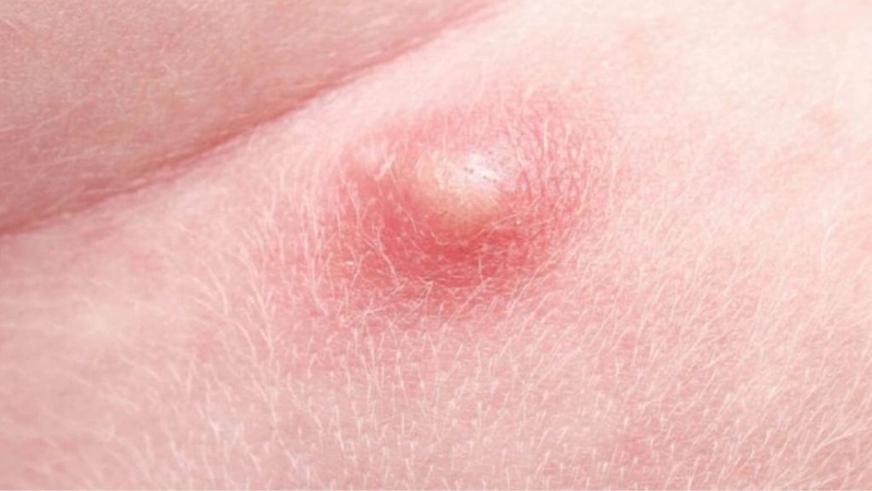 Nổi mụn ở mép vùng kín nữ: Nguyên nhân, cách phòng bệnh 1