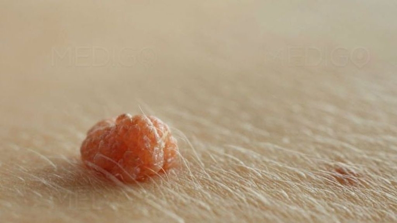 Nổi mụn ở mép vùng kín nữ: Nguyên nhân, cách phòng bệnh 2