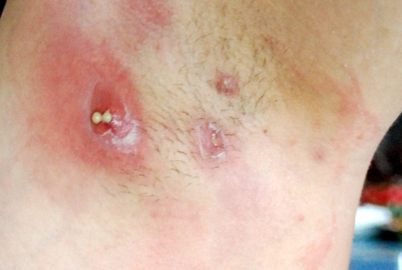 Nguyên nhân nổi mụn ở nách do đâu