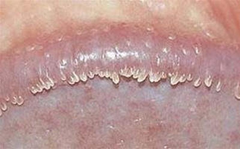 Nổi mụn trắng ở bao quy đầu là dấu hiệu của bệnh gì?1