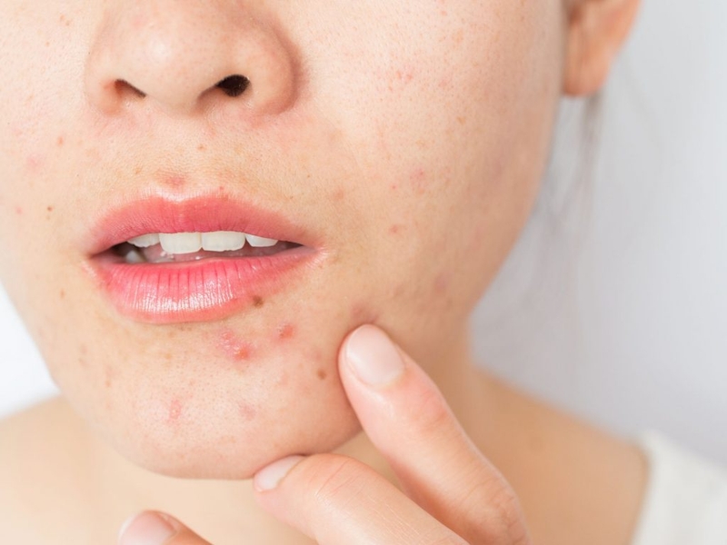 Nổi mụn trứng cá gần miệng nguyên nhân là do đâu?1