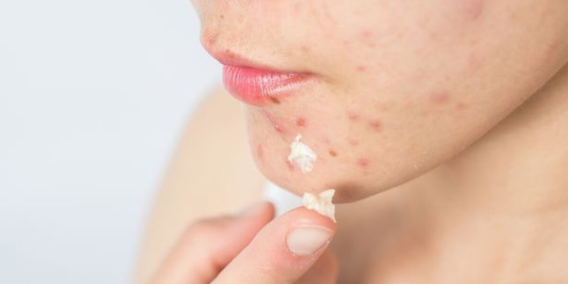 Nổi mụn trứng cá gần miệng nguyên nhân là do đâu?3