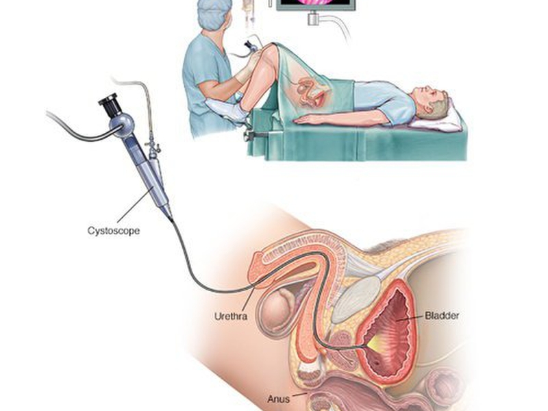 Cả hai loại nội soi bàng quang bằng ống cứng và mềm đều có những ưu điểm riêng