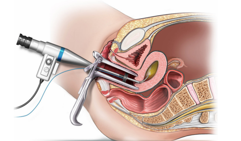 Nội soi buồng tử cung là một phương pháp sử dụng các dụng cụ hỗ trợ để quan sát bên trong của tử cung.