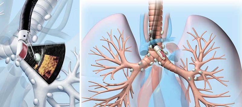 Nội soi phế quản có dễ xảy ra biến chứng không? 1