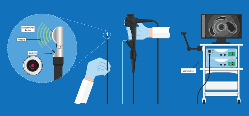 Nội soi siêu âm đường tiêu hóa trên: Để làm gì? Thực hiện như thế nào? 2