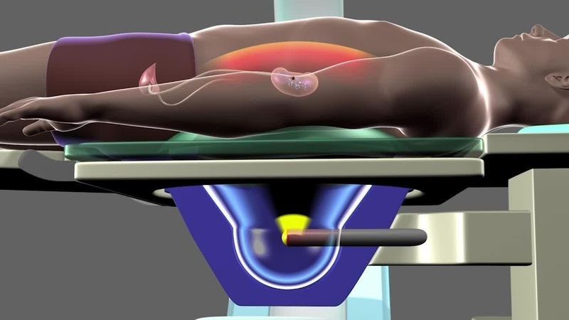 Nội soi tán sỏi ngoài cơ thể (ESWL) phù hợp với bệnh nhân nào? Được thực hiện ra sao? 3