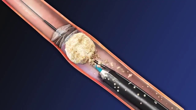 Nội soi tán sỏi ngược dòng bằng ống mềm 2