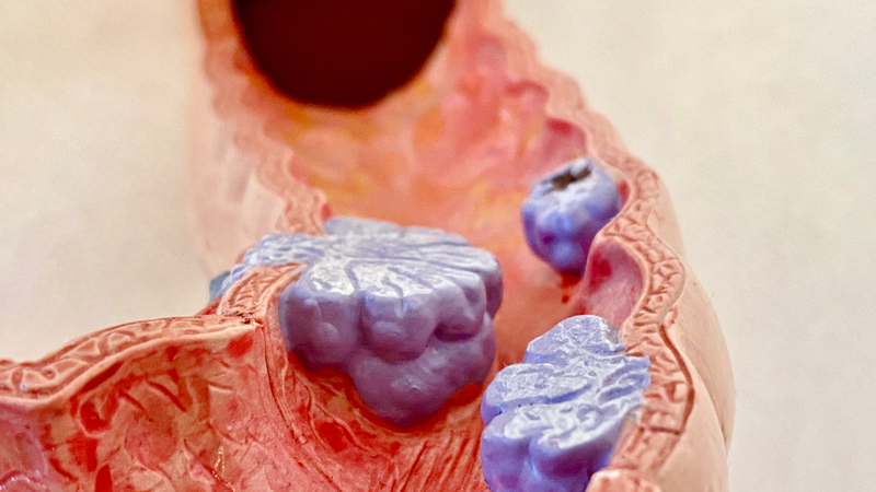 Nội soi tiêu hóa dưới: Phương pháp chẩn đoán hiệu quả các bệnh lý đường ruột 2