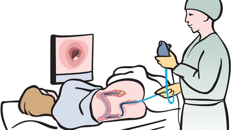 Nội soi trực tràng: Quy trình và những lưu ý khi thực hiện 3