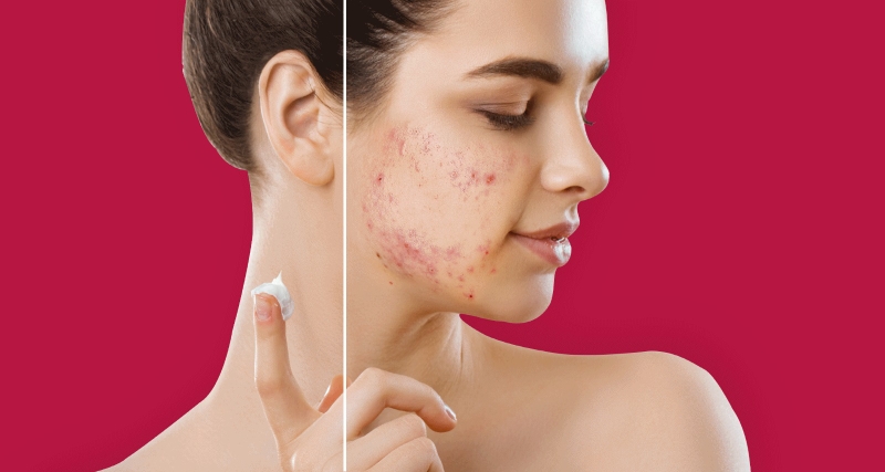 Non comedogenic là gì? Có nên sử dụng nó khi chăm sóc da