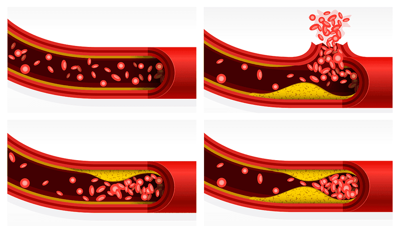 Non HDL cholesterol là gì và tầm quan trọng của nó đối với sức khỏe 3