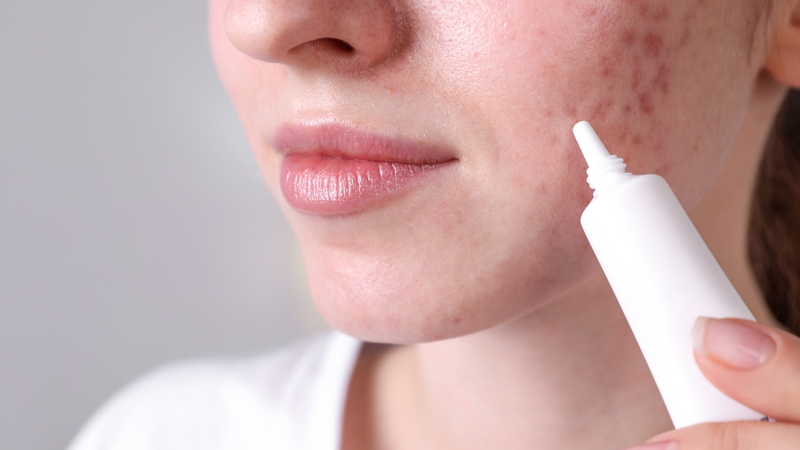 Nồng độ Tretinoin có mấy loại? Có hiệu quả như thế nào? 3