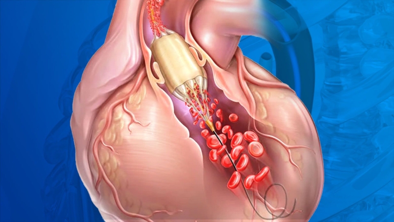 Nong van tim: Tổng quan, chỉ định, quy trình và những lưu ý cần biết 1