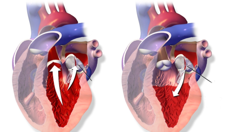 Nong van tim: Tổng quan, chỉ định, quy trình và những lưu ý cần biết 2