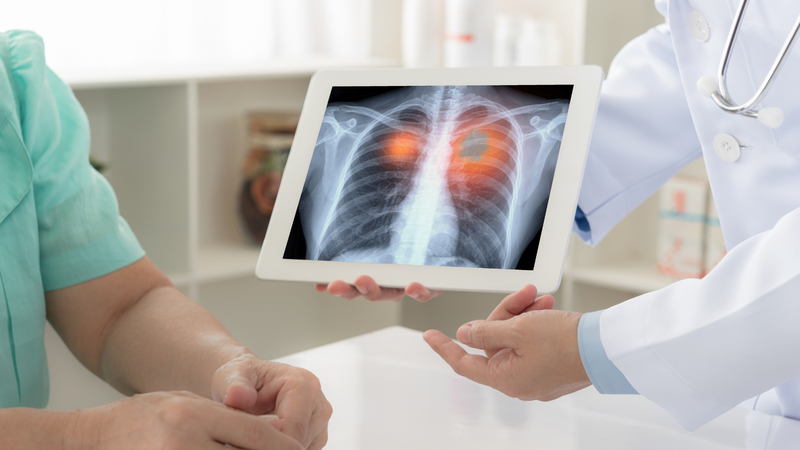 Một nốt phổi có thể là khối u ác tính xuất phát từ chính các tế bào của phổi