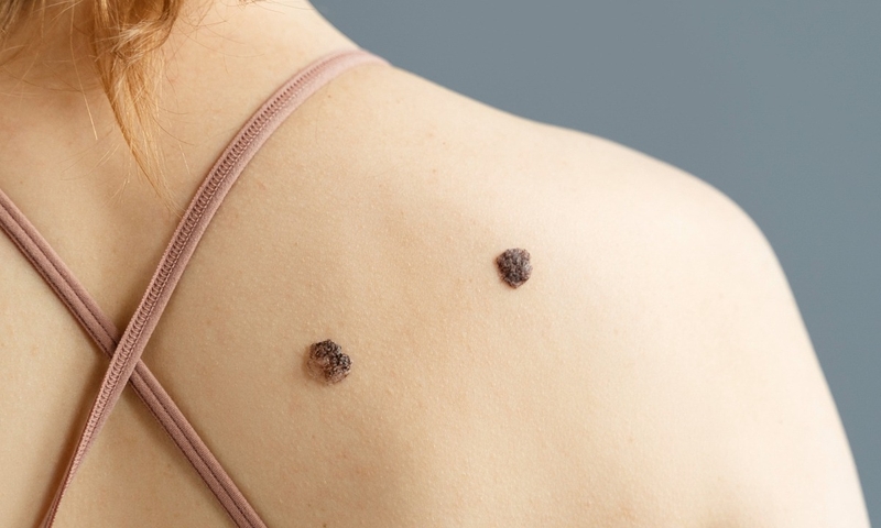 not-ruoi-ac-tinh-la-gi-cach-nhan-biet-not-ruoi-ac-tinh 2.jpg