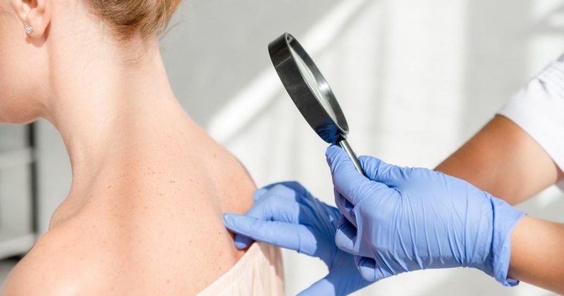 not-ruoi-ac-tinh-la-gi-cach-nhan-biet-not-ruoi-ac-tinh 3.jpg