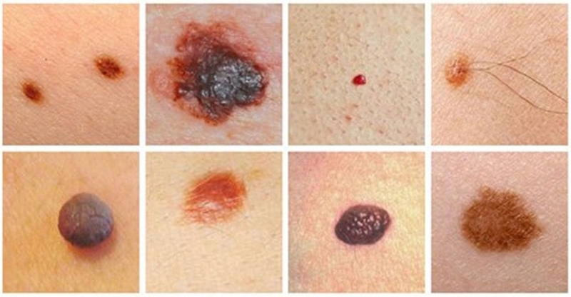 Sự thật: Nốt ruồi bẩm sinh có tẩy được không? 2