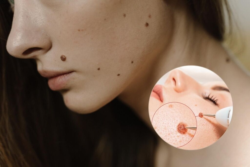 Sự thật: Nốt ruồi bẩm sinh có tẩy được không? 4