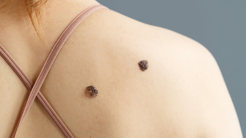 Nốt ruồi có di truyền không? Cách nhận biết nốt ruồi lành tính và ác tính 3