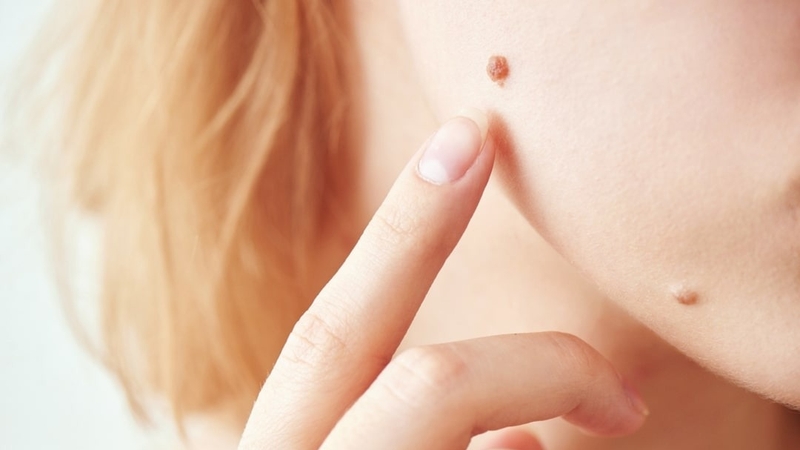 Nốt ruồi hình thành thế nào? Nguyên nhân và cách phân loại 3