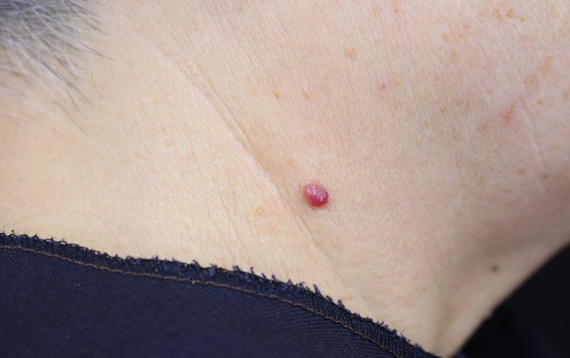 Nốt ruồi son ở cổ đàn ông có phải bệnh lý không? Giải thích sự hình thành 1