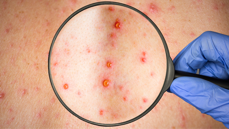 Nốt thủy đậu chuyển sang màu trắng đục là dấu hiệu gì? 1