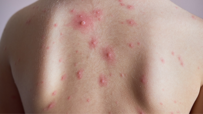 Nốt thủy đậu chuyển sang màu trắng đục là dấu hiệu gì? 2