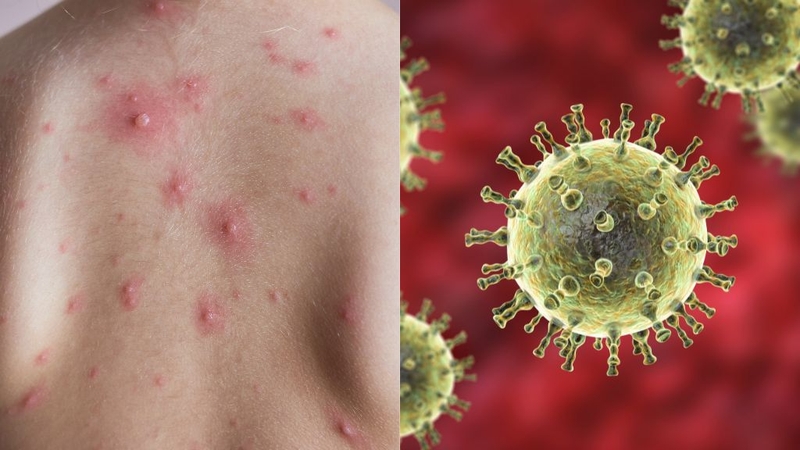 Nốt thủy đậu có mủ phải làm sao? Có nguy hiểm không? 1