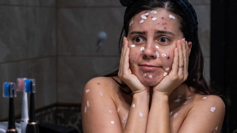 Nốt thủy đậu có mủ phải làm sao? Có nguy hiểm không? 3