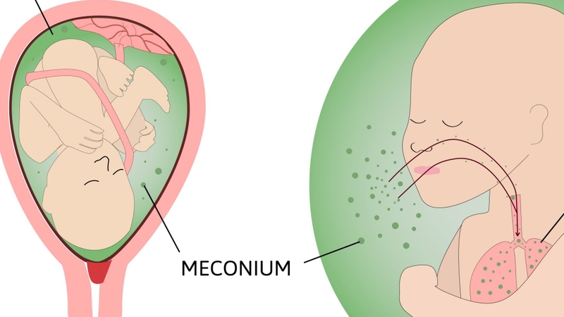 Hội chứng hít phân su (MAS) có thể làm nước ối có màu xanh 3