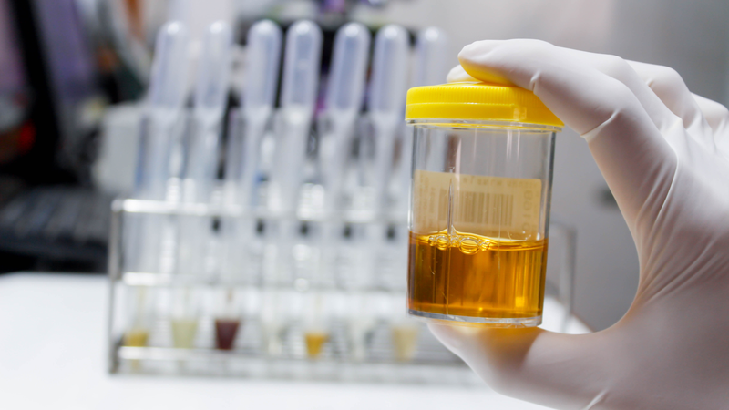 Nước tiểu đổi màu nói lên điều gì?4